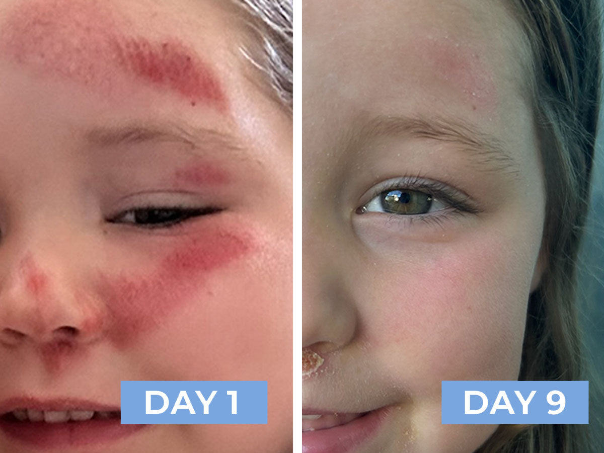 Before and after comparison of a child's skin condition on Day 1 and Day 9 after using RESTORE24.