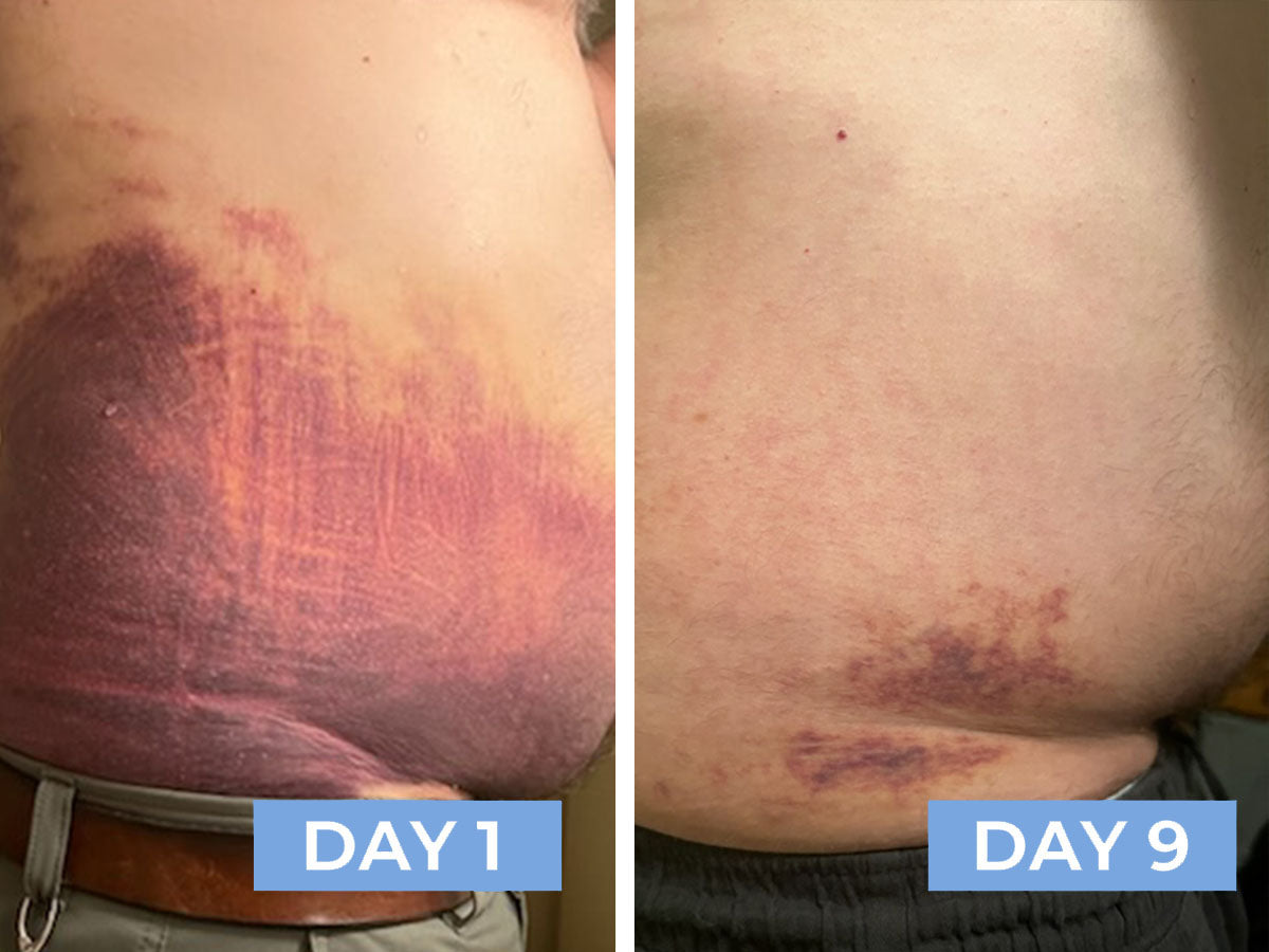 Before and after comparison of a man's bruise on Day 1 and Day 9 after using RESTORE24.