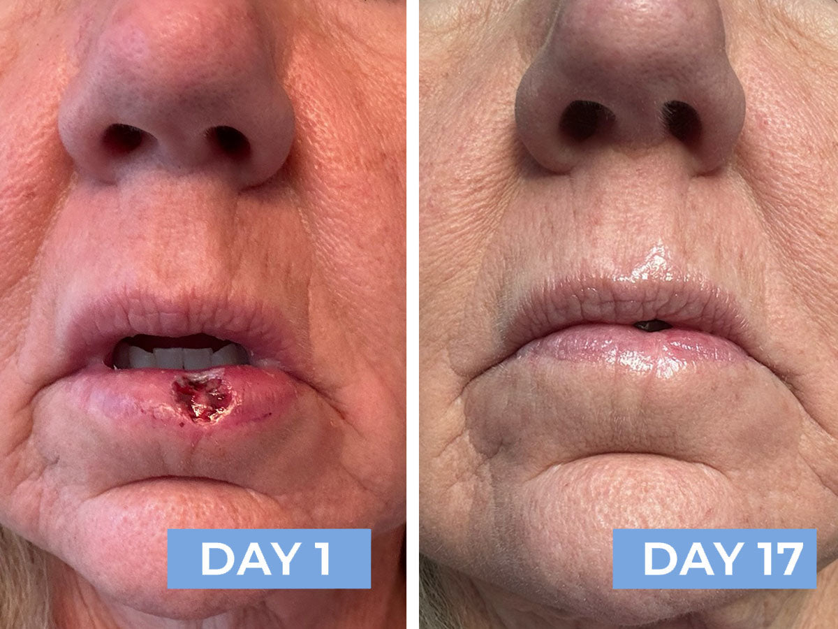 Before and after comparison of a woman's lip on Days 1 and 17 after using RESTORE24.