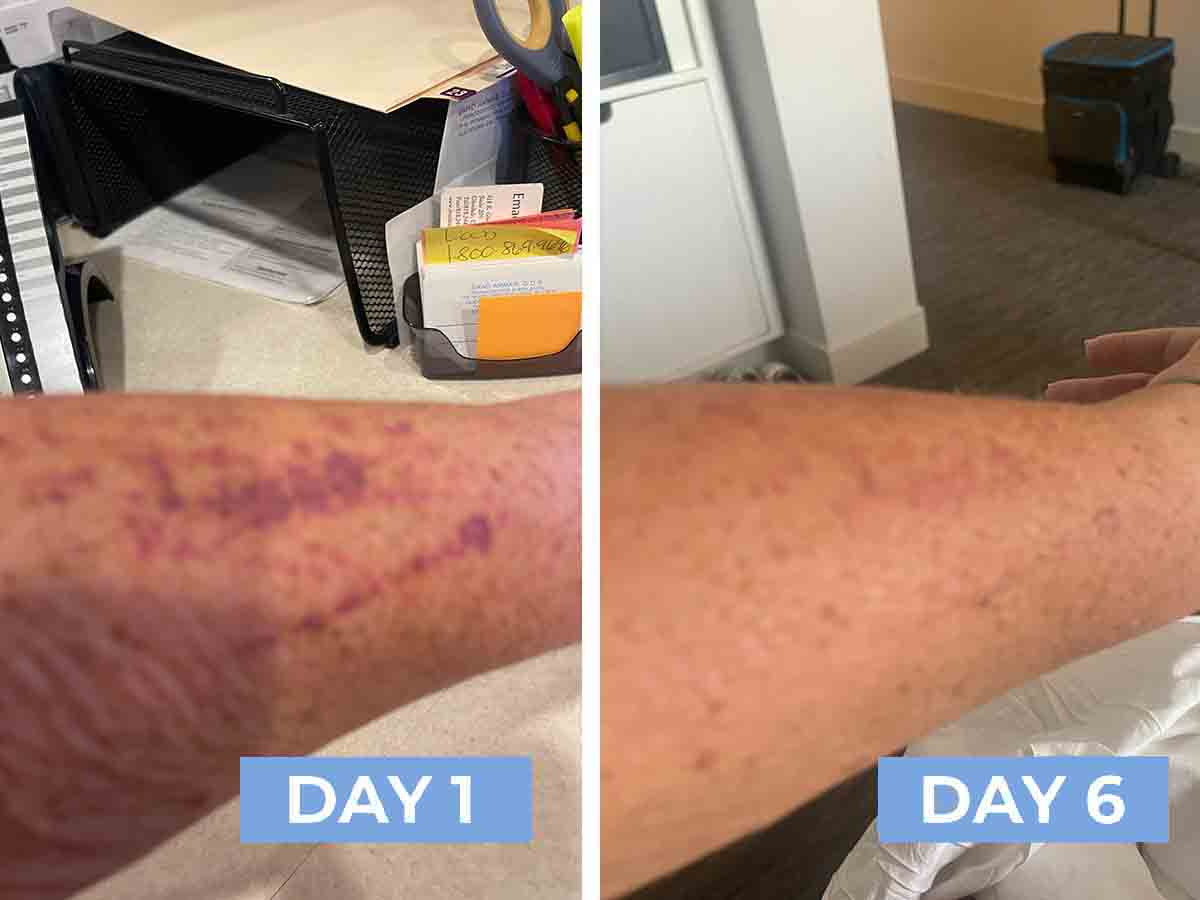 Before and after comparison of a person's arm with visible redness and bruising on Day 1 and reduced redness on Day 6.