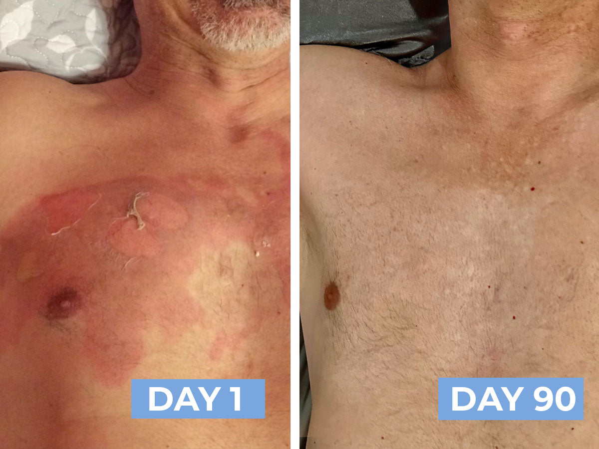 Before and after comparison of a man's chest with visible skin conditions on Day 1 and Day 90.