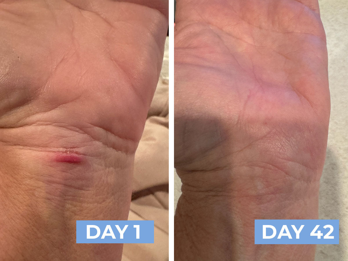 Before and after comparison of a skin condition on a person's wrist, labeled 'Day 1' and 'Day 42'.